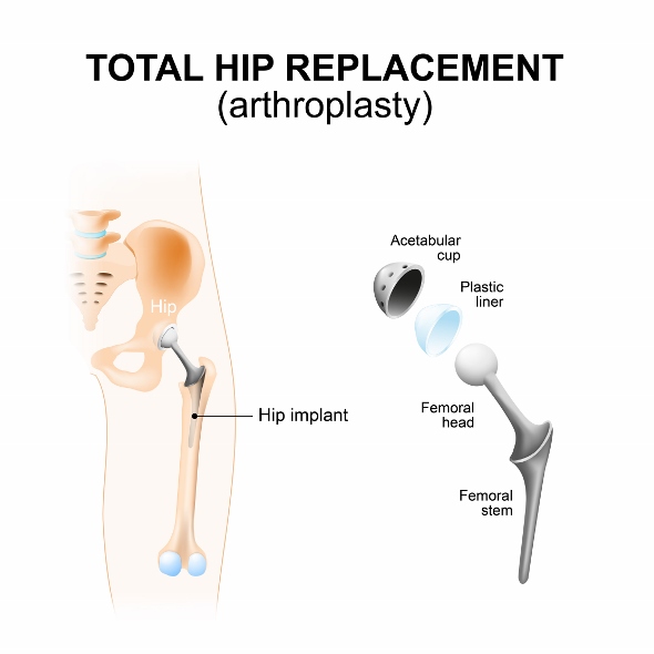 Focus On: Hip Replacement Surgery.