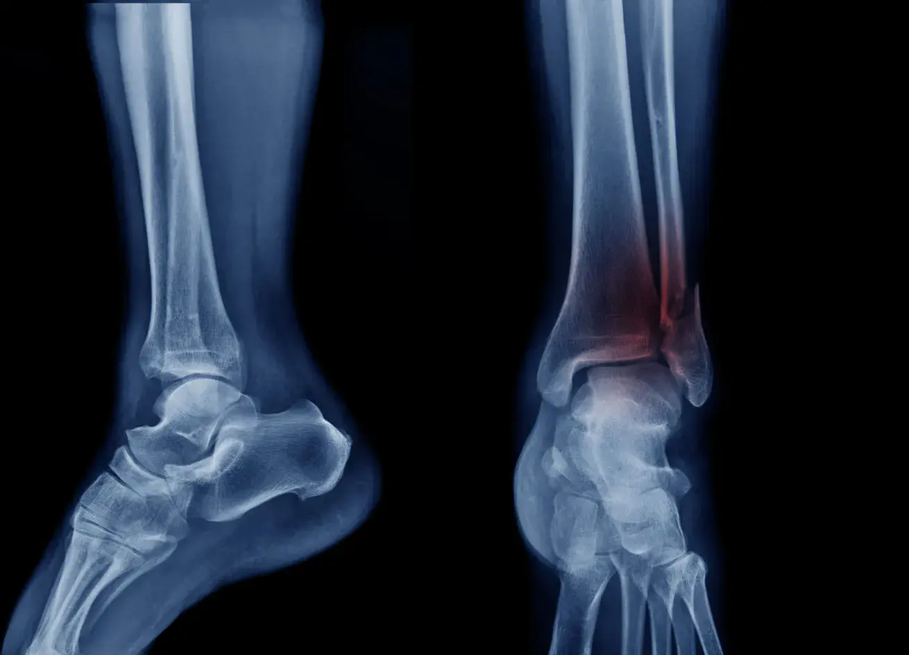 X-ray image of the ankle